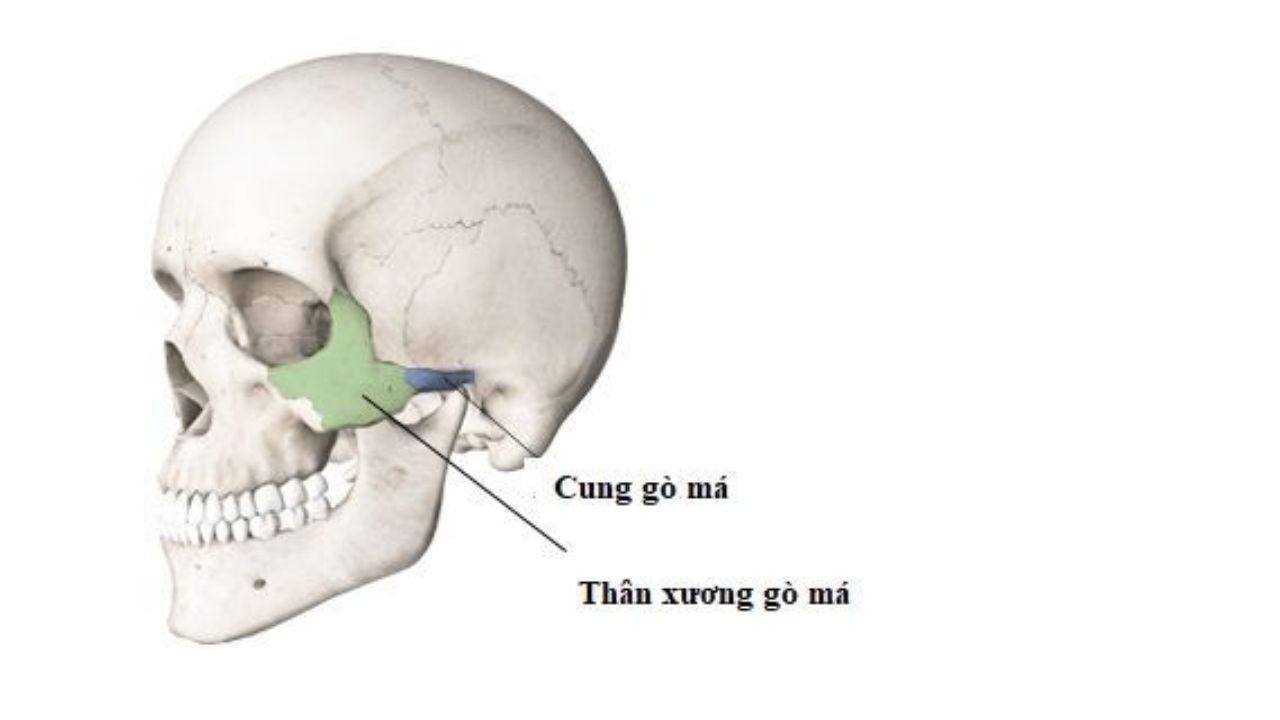 gãy xương gò má - Image 5