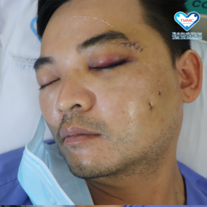 gãy xương gò má không phẫu thuật
