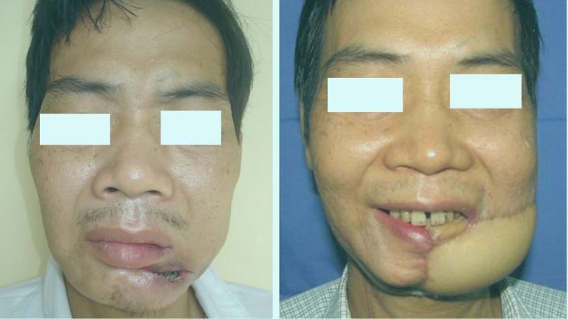 gãy xương hàm - Image 5
