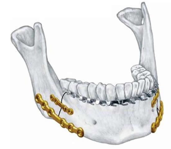 gãy xương hàm dưới - Image 3