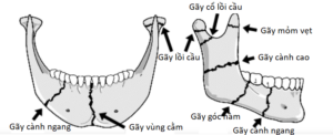 gãy xương hàm dưới