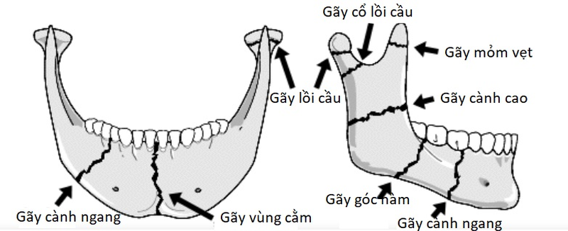 gãy xương hàm dưới bao lâu thì lành - Image 2