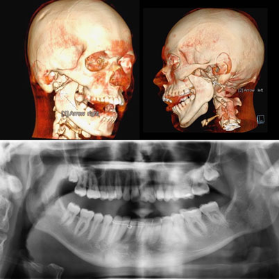 gãy xương hàm dưới vùng cằm - Image 3