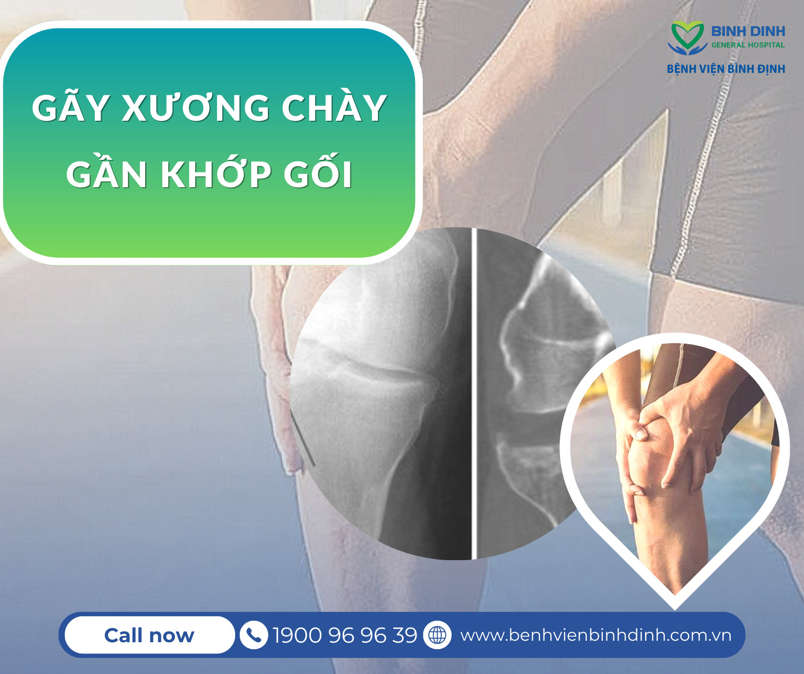 gãy xương khớp gối - Image 4