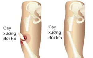 gãy xương kín