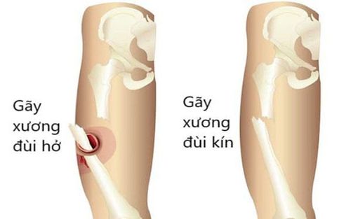 gãy xương kín