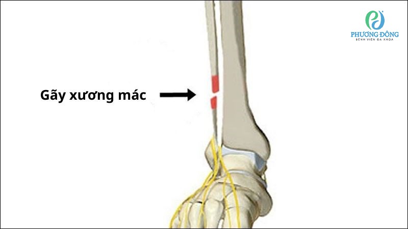 gãy xương mác có nên mổ không - Image 3