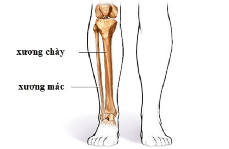 gãy xương mác có nên mổ không