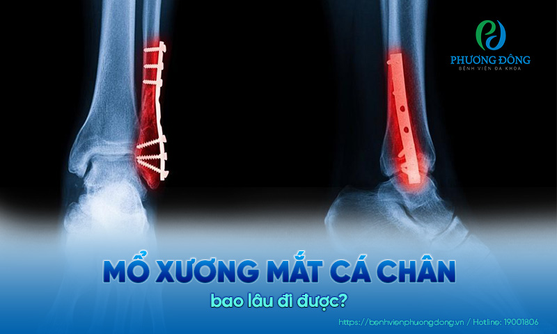gãy xương mắt cá chân bao lâu lành - Image 3