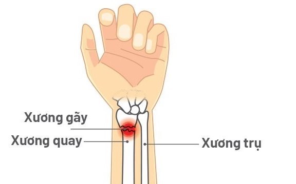 gãy xương quay cổ tay bao lâu thì khỏi