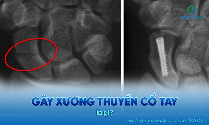 gãy xương thuyền - Image 5