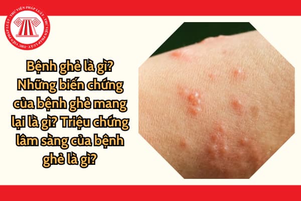 ghẻ - Image 4