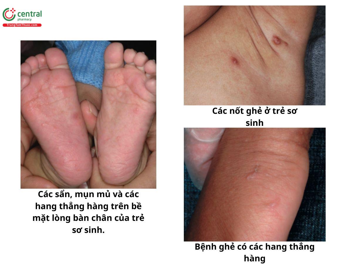 ghẻ Na Uy - Image 3