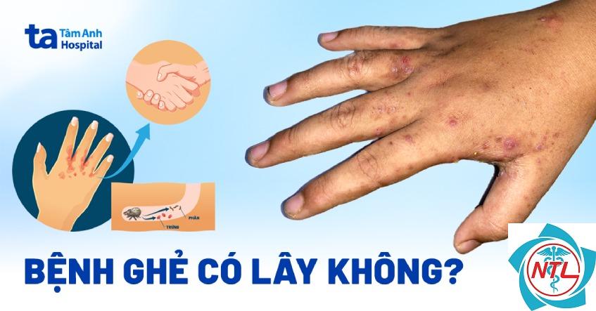 ghẻ lây qua tiếp xúc - Image 5