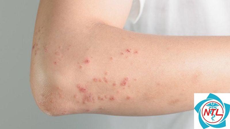 ghẻ lây qua tiếp xúc