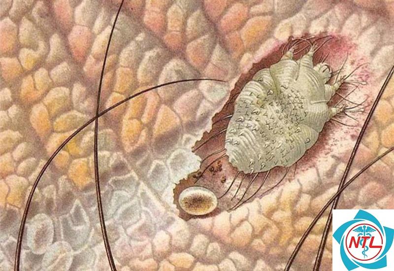 ghẻ ở bộ phận sinh dục - Image 2