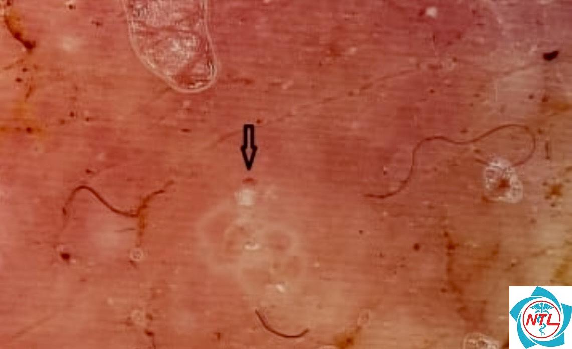 ghẻ ở bộ phận sinh dục - Image 3