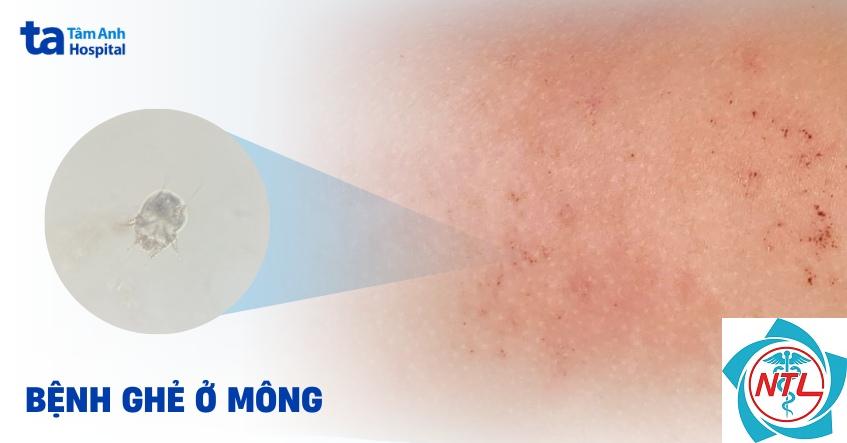 ghẻ ở mông - Image 2
