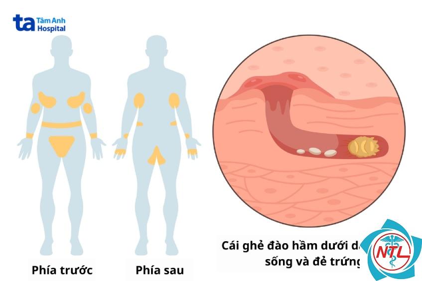 ghẻ ở mông - Image 3