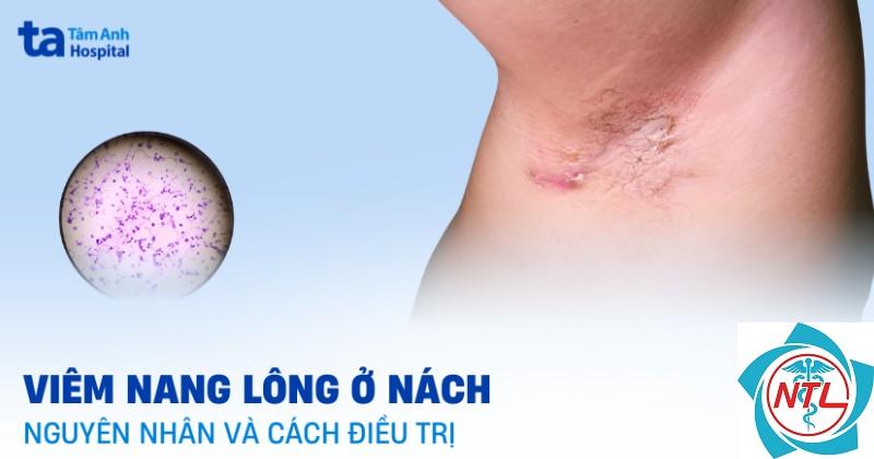 ghẻ ở nách - Image 3