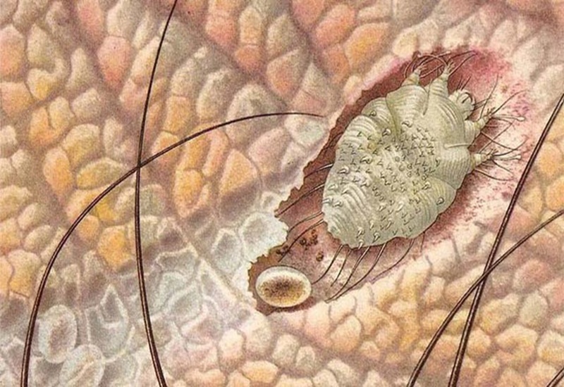 ghẻ ở vùng sinh dục - Image 2