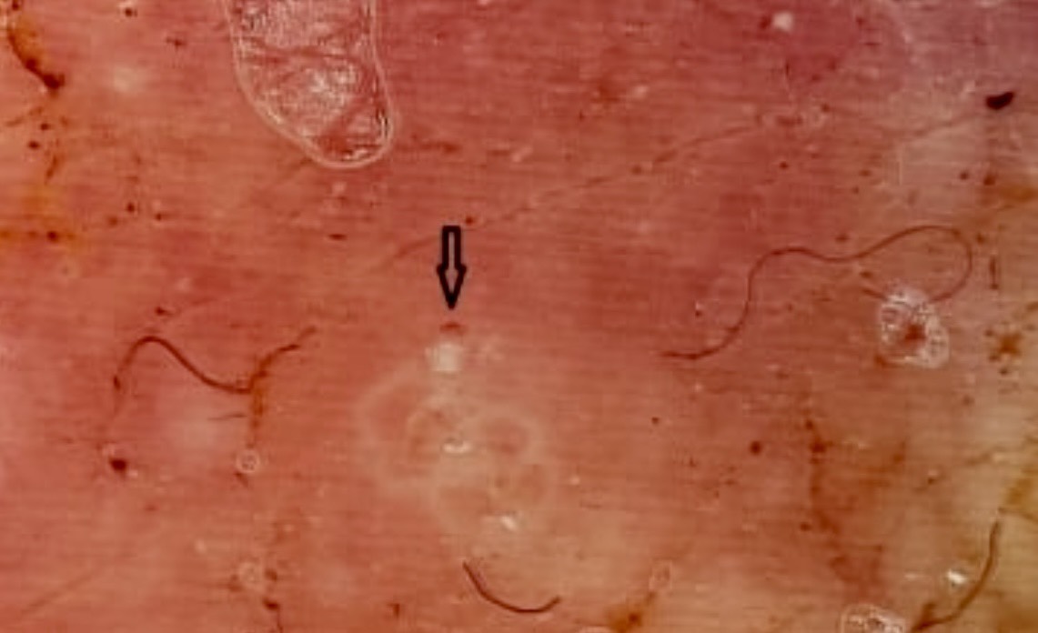 ghẻ ở vùng sinh dục - Image 3