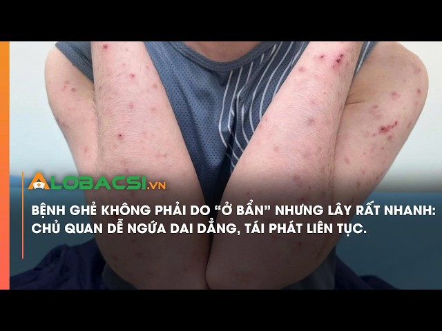 ghẻ tái phát - Image 4