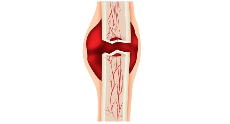 giải thích hiện tượng liền xương khi gãy - Image 2