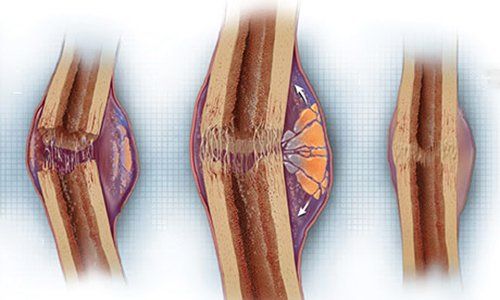 giải thích hiện tượng liền xương khi gãy - Image 3