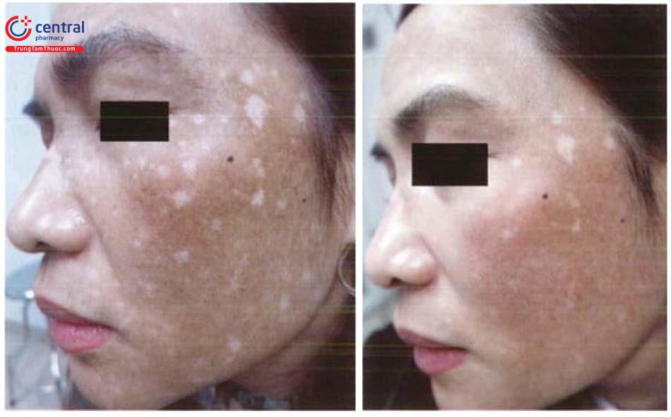 giảm sắc tố da - Image 3