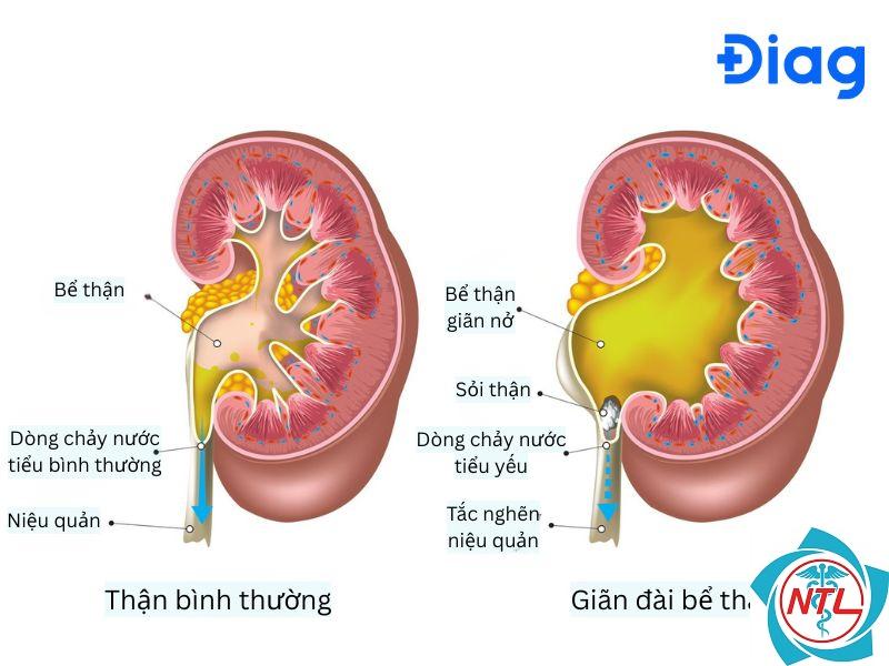 giãn bể thận - Image 2