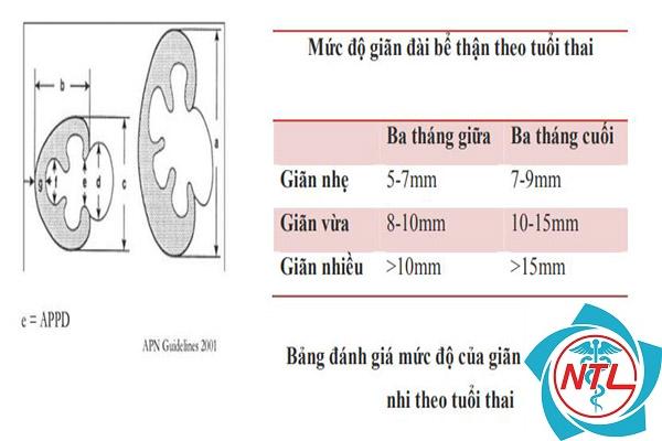 giãn bể thận - Image 3
