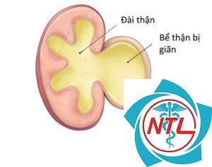 giãn bể thận