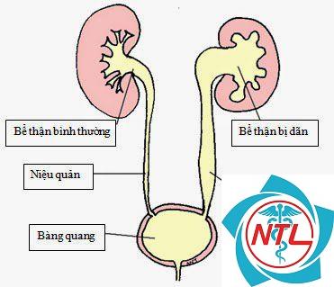 giãn bể thận - Image 4