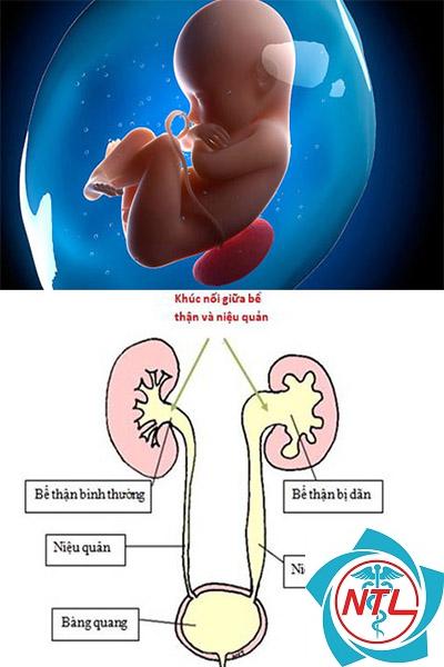 giãn bể thận bẩm sinh - Image 4