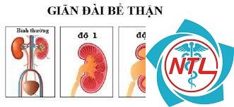 giãn bể thận ở trẻ sơ sinh - Image 3
