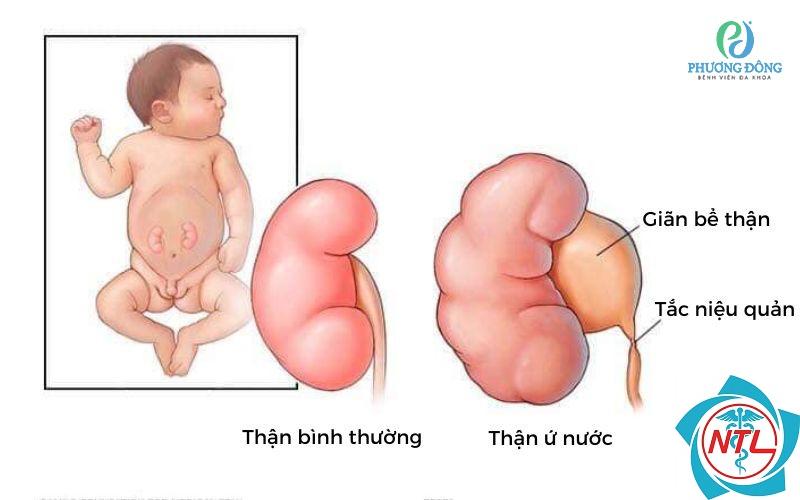 giãn bể thận ở trẻ sơ sinh - Image 4