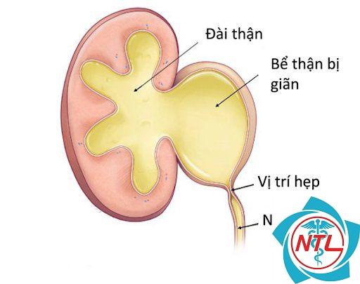 giãn bể thận