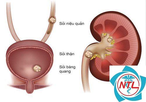 giãn đài bể thận một bên - Image 2