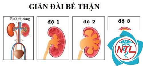 giãn đài bể thận một bên - Image 4