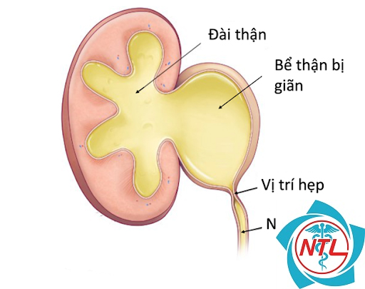 giãn đài bể thận một bên