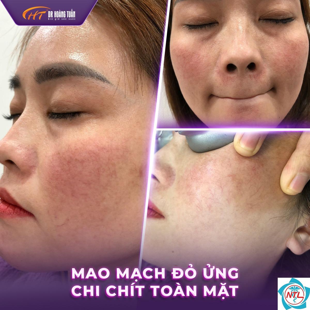 giãn mạch da mặt - Image 2
