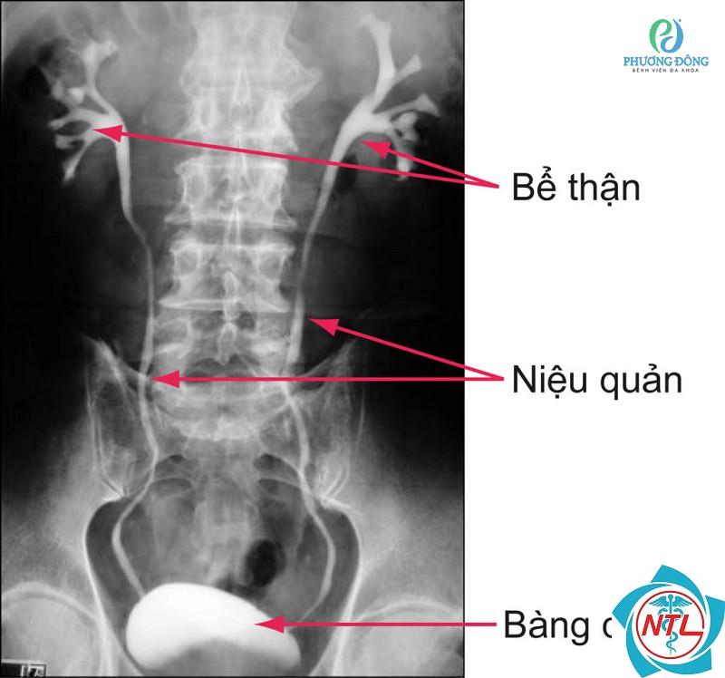 giãn niệu quản - Image 3