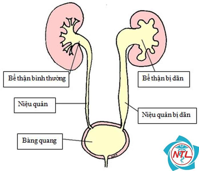 giãn niệu quản - Image 4