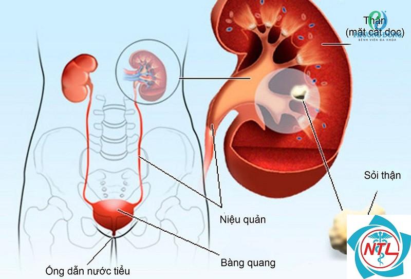 giãn niệu quản