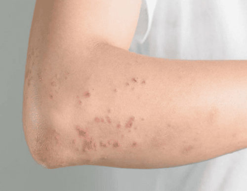 giun sán có lây từ mẹ sang con không - Image 2