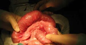giun trong bụng bé 3 tuổi
