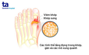 gout cấp tính