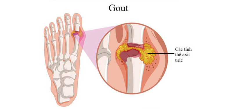 gout cấp tính - Image 4