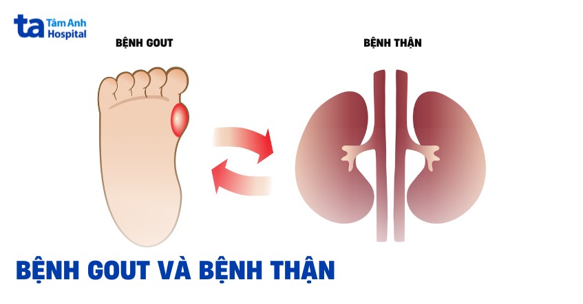 gout kèm bệnh thận - Image 2
